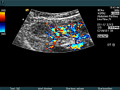 right kidney with afbn (acute focal bacterial nephritis)